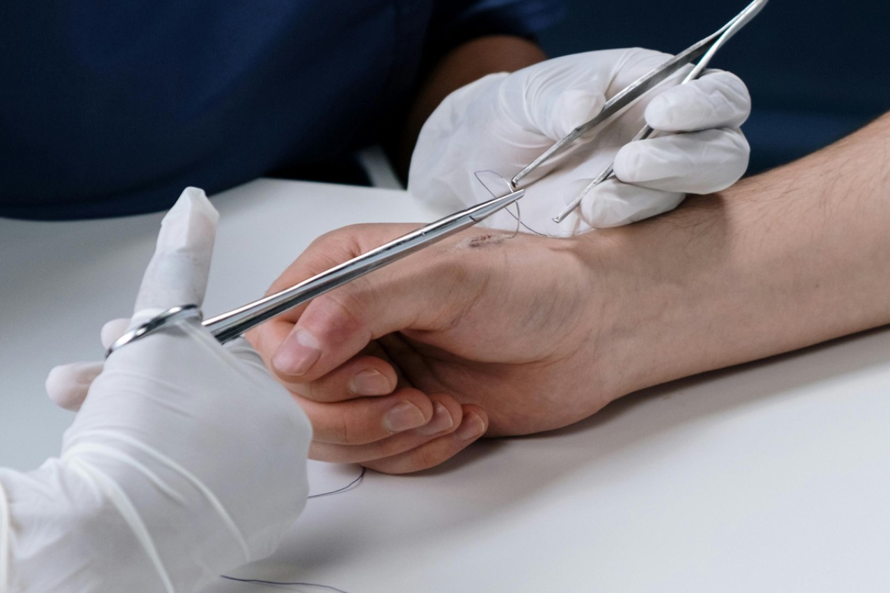 Wond hechten: tips en adviezen voor een optimale genezing