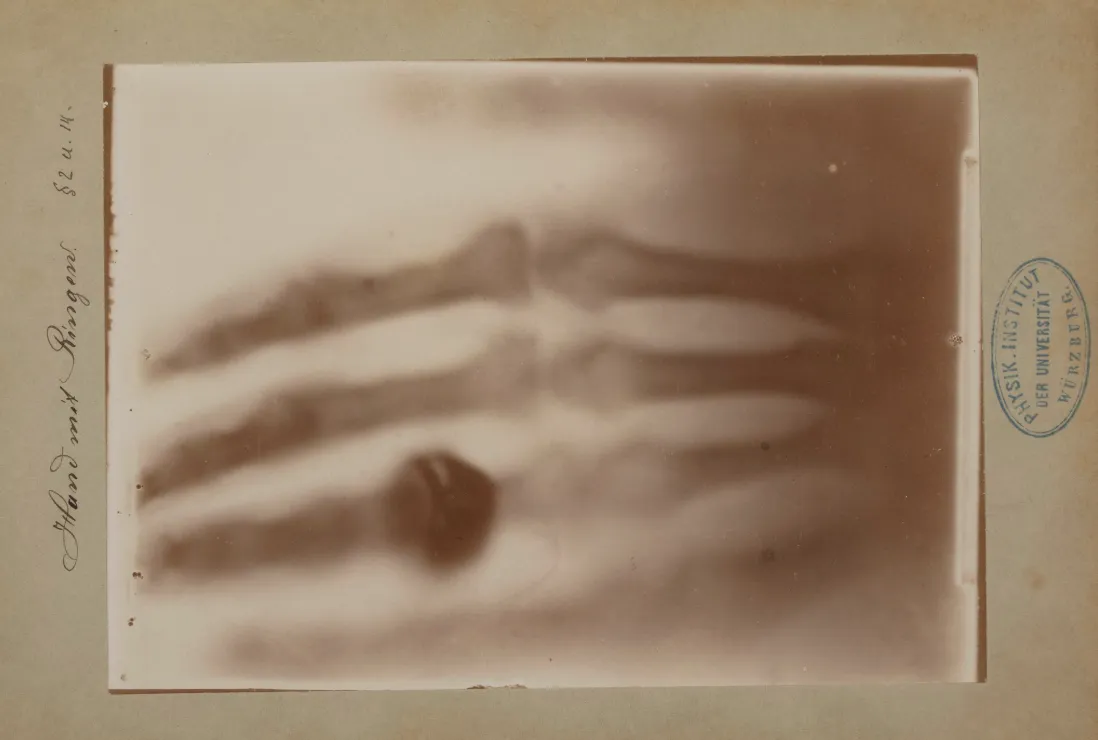 Oudste röntgenfoto ooit gevonden - Medigo actueel